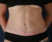 Feel Beautiful - Texas Tummy Tuck - After Photo